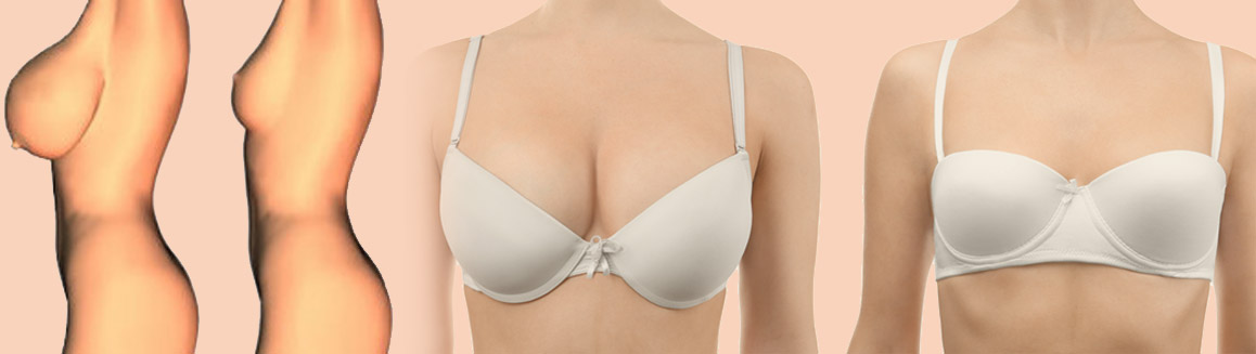BREAST REDUCTION, BREAST SURGERY
