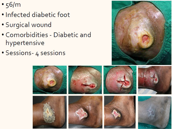 At Elrevo Clinic Diabetic Foot Results