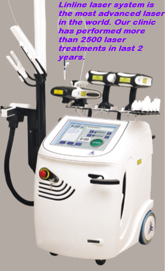 laser treatment
