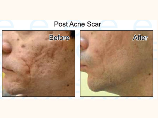 Post acne Scar, SCAR TREATMENT